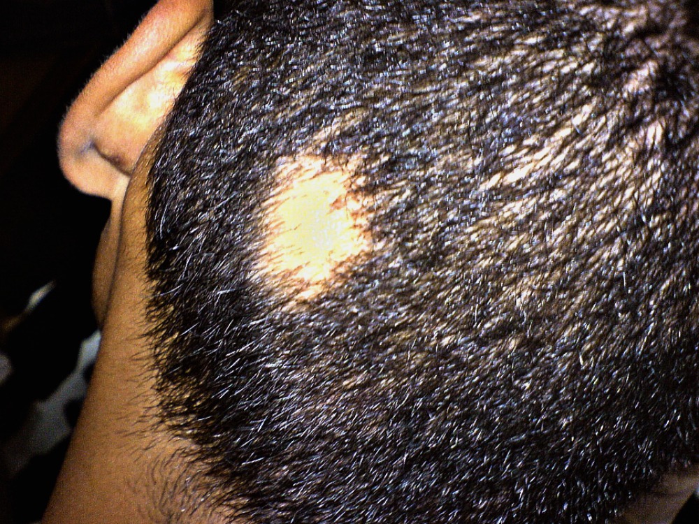 patch of hair missing from the back of a man's head because he's stressed out