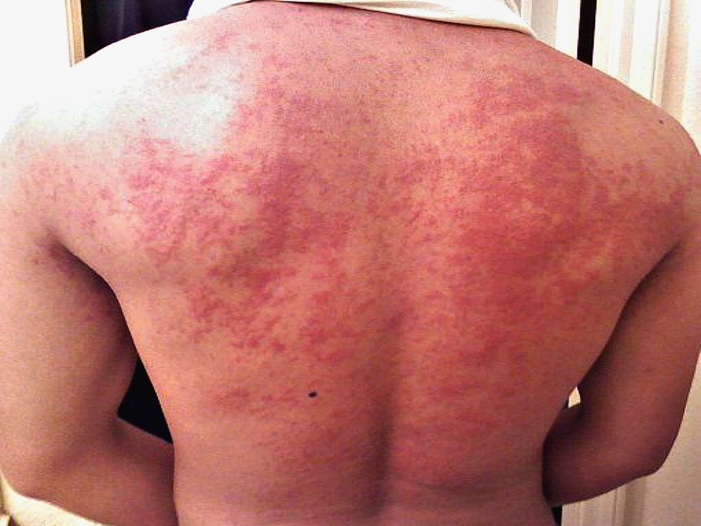 Symptoms of Stress - Red hives breakout on a man's back because he's stressed out